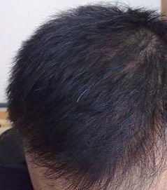 侧柏叶洗头真实经历